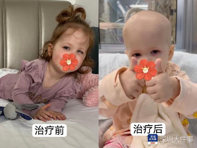 基因治療“逆天改命”！瑞典罕見遺傳病患兒萬里赴粵重獲新生(圖2)