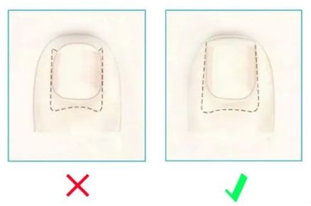 孩子指甲軟薄易斷、月牙少、長(zhǎng)白點(diǎn)、豎紋是顯示身體有健康風(fēng)險(xiǎn)嗎？(圖13)